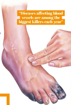  ?? ?? When blood flow is cut off from the feet, cells can begin to die, leading to gangrene