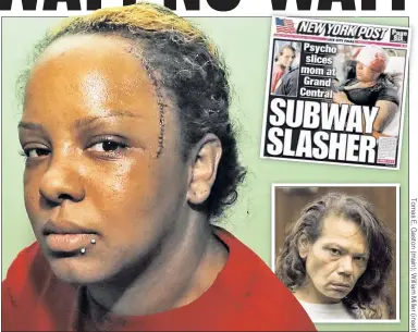  ??  ?? ‘I’M AFRAID’: Slashing victim Anna Martinez shows the 30 stitches she needed after being attacked, allegedly by homeless woman Jacqueline Sanjurjo (inset), on the subway Sunday, as reported by The Post (top).