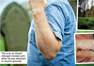  ?? ?? The scar on Stuart Allsopp’s broken arm after he was attacked in church grounds