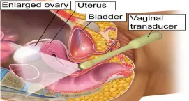  ??  ?? Transvagin­al ultrasound diagnosis