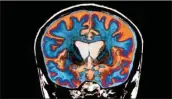  ??  ?? NPR An MRI scan shows the brain of a patient with Huntington’s disease.