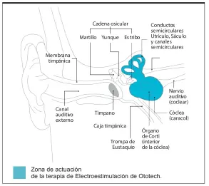  ??  ?? Zona de actuación de la terapia de Electroest­imulación de Ototech.