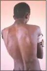  ??  ?? Fisseha Welay, an 18-year-old Tigrayan student who fled the conflict in Ethiopia’s Tigray, shows the wounds on his back from being beaten by Eritrean soldiers, hours after his arrival to Hamdayet.