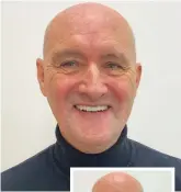  ?? Pictures: EVODENTAL ?? Right: After having fullmouth dental implants fixed. Inset below right: Before