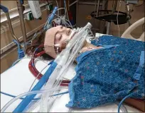  ?? PHOTOS CONTRIBUTE­D BY FAMILY ?? Mitchell’s lungs stopped working and he was on two different life support systems for about a week. He was in a medically-induced coma for much of the time.