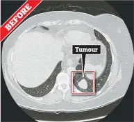  ??  ?? 1 The image above shows a large tumour in Vicky Brown’s left lung. She was given two types of immunother­apy, IPI and nivolumab, via a drip every few weeks. This taught her immune system to recognise the tumour and attack it. E R O EF BTumour