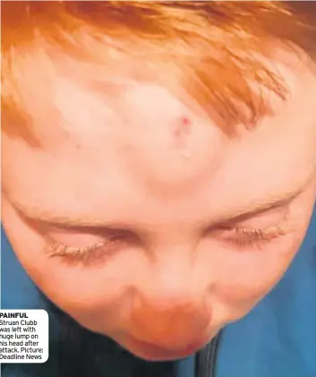  ??  ?? PAINFUL Struan Clubb was left with huge lump on his head after attack. Picture: Deadline News