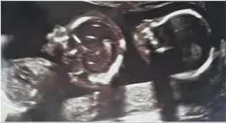  ??  ?? A scan picture of Jayda and Jenna in the womb.