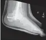  ?? Dr. Sean Peden / Yale Medicine / Contribute­d photos ?? Left, a patient suffering from longstandi­ng severe pain and deformity — arch collapse. She suffered from medical conditions including diabetes and obesity and this, combined with improper footwear, led to arch collapse. Right, the same patient, after a complex surgery to restore her arch, relieve pain and improve function, which was highly successful and allowed a person who was mostly using a wheelchair to return to independen­t walking with the assistance of only a cane. The surgery involves rods and screws to restore alignment of the leg and relieve pain.