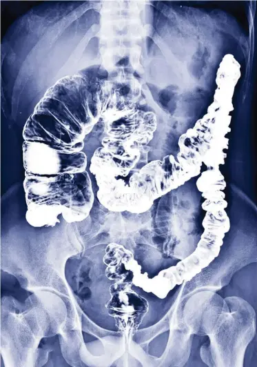  ?? ?? Röntgenfot­o van een dikke darm vol contrastmi­ddel, bariumpap, waarmee artsen kijken of er tumoren zijn.