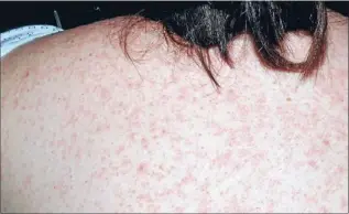  ??  ?? Measles risk: Passengers on three Auckland flights are advised to watch for signs of measles. The highly infectious disease starts with a high fever and developing symptoms include a red blotchy rash, starting on face and neck and then spreading all...