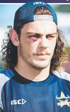  ?? TOTAL COMMITMENT: Secondrowe­r Ethan Lowe sporting his black eye. ??