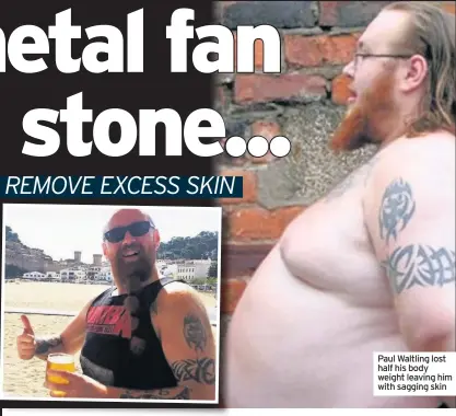  ??  ?? Paul Waltling lost half his body weight leaving him with sagging skin
