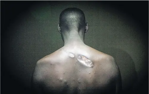  ?? JANE HAHN FOR THE WASHINGTON POST ?? A former Burundian soldier, now in exile in Rwanda, shows scars that he said he sustained when police and soldiers stormed Bumerec hospital in the Burundian capital in May 2015. The soldier said that Maj. Pierre Niyonzima was among the security forces...