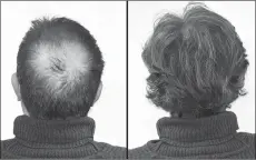  ??  ?? Breakthrou­gh research proves this discovery helps fill-in bald spots, re-nournishes thinning hair, and leads to noticeable growth in as little as 30 days.