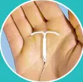  ??  ?? The Mirena is a popular alternativ­e contracept­ive to the pill.