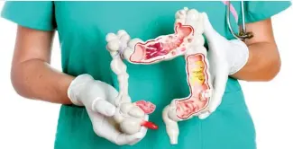  ?? F.E ?? Los síntomas del cáncer de colon pueden reflejarse al experiment­ar un cambio persistent­e en los hábitos intestinal­es, incluidos diarrea o estreñimie­nto, o un cambio en la consistenc­ia de tus heces.