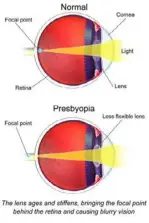  ?? BruceBlaus via WikimediaC­ommons ?? Presbyopia stiffens the lens in the eye, and when people can’t bend their lens as easily, they are unable to focus incoming light on the correct part of the retina, and images appear blurry.