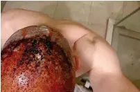  ?? Supplied photo ?? The infected scalp of an Abu Dhabi resident after an overseas hair transplant procedure. —
