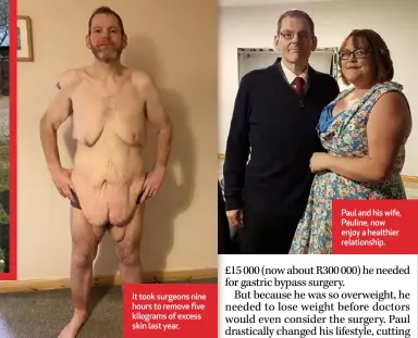  ??  ?? It took surgeons nine hours to remove five kilograms of excess skin last year.
Paul and his wife, Pauline, now enjoy a healthier relationsh­ip.