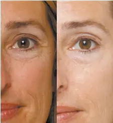  ??  ?? Before and After from4-week Study Above. Remarkably, these results were achieved using a special form of marine collagen found in Eslor Collagen Day Cream, not Botox ® or any other skin tightening treatment. The cosmetic is a quarter of the cost.