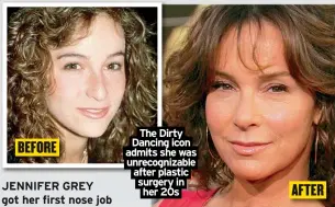  ?? ?? The Dirty Dancing icon admits she was unrecogniz­able after plastic surgery in her 20s BEFORE AFTER