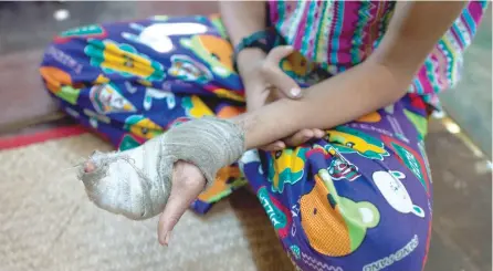  ?? — AFP ?? 14-year-old San Min Hteik, shows his injured hand during an interview at his home in the Myaung Dakar industrial zone in Hmawbi Township in Yangon.