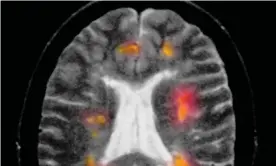  ?? Photograph: Callista/Getty/Image Source ?? A MRI scan shows a patient with multiple sclerosis. The disease destroys the protective myelin coating of nerves in the brain and spinal cord.