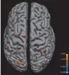  ??  ?? Cerebral areas where the “Christmas group” had a significan­tly higher increase in cerebral activity than the “non-Christmas group” while images viewed had a Christmas theme. The color scale is of z values representi­ng response of “Christmas group”...