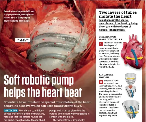  ??  ?? The soft sleeve has proved efficient in pig experiment­s, making hearts recover 88 % of their pumping power following heart failure.