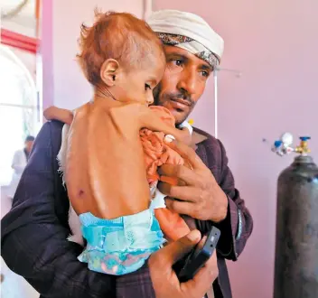 ?? PHOTO AFP ?? Un père porte son enfant malnutri dans un hôpital de Sanaa, la capitale du Yémen.