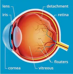  ??  ?? Floaters become more mobile and visible as the vitreous liquefies with age and separates from the retina.