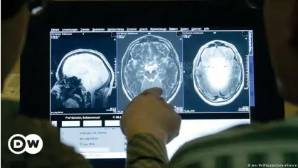  ?? ?? Científico­s estudian las secuelas del Alzheimer y otros males en el cerebro