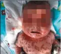  ??  ?? 三個月大女嬰全身長滿­皰疹，體無完膚，經治療後目前情況已好­轉。 (取材自微博)