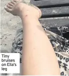  ??  ?? Tiny bruises on Ella’s leg