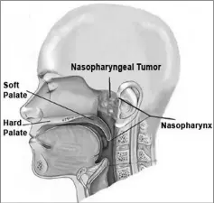  ??  ?? Diagram shows a nasopharyn­geal tumour. Source: Internatio­nal Medical University.