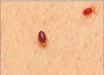  ?? SUBMITTED PHOTO ?? Close-up of bed bugs on human skin.