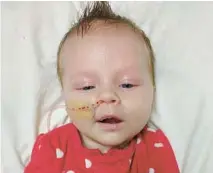  ?? FAMILY PHOTO ?? Tess Merrell’s fourth child, Eleanor, spent Christmas Eve 2017 attached to a feeding tube after her“tonguetie release” surgery. Eleanor stopped eating and became dehydrated after the procedure. Merrell said she and her family “felt really stupid afterward because we paid to hurt our baby.”