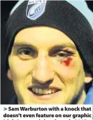  ??  ?? > Sam Warburton with a knock that doesn’t even feature on our graphic (right); an eye injury in early 2015