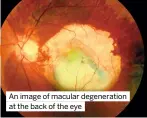  ?? ?? An image of macular degenerati­on at the back of the eye