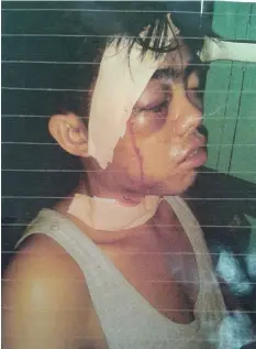  ?? CONTRIBUTE­D PHOTO ?? Injury to the right eye of Joe Henry Bagul, 24, of Carcar City, Cebu is so extensive doctors have no recourse but to remove it today after a policeman and neighbors allegedly mauled him in Bulacao, Cebu City supposedly for theft.