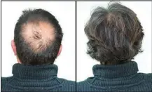  ?? ?? Breakthrou­gh research proves this discovery helps fill-in bald spots, re-nournishes thinning hair, and leads to noticeable growth in as little as 30 days.