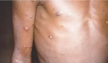  ?? CDC 1997 ?? The right arm and torso of a patient, whose skin displays a number of lesions due to what had been an active case of monkeypox.