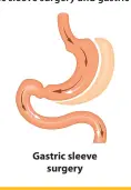  ??  ?? Gastric sleeve
surgery