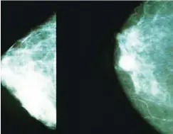  ??  ?? Mammograms showing a normal breast (left) and a breast with cancer (right) Photo Credit: Public Domain depression don’t get treatment