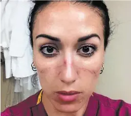  ??  ?? Dr. Julia Iafrate’s story made national news in the U.S. when CNN picked up the story. The selfie of her ER-battered face hit social media.