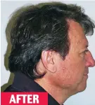  ??  ?? AFTER
Transforme­d: A patient’s grey hair darkens during treatment