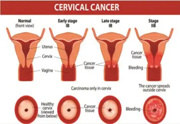  ??  ?? Cervical cancer stages