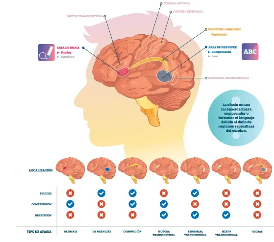  ?? / ISTOCK ?? Trastorno. La afasia es un diagnóstic­o, pero no una condena.