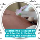 ??  ?? Septicaemi­a is caused by an infection in the body entering the bloodstrea­m